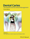 Dental Caries - The disease and its clinical management